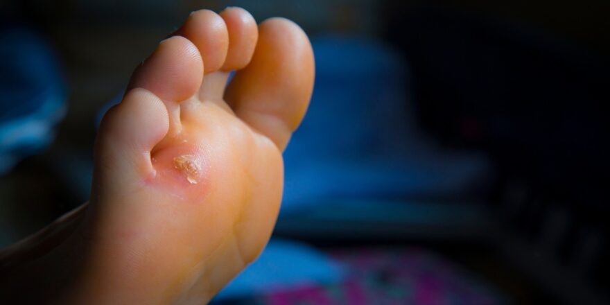 homeopathic treatment for corns and calluses