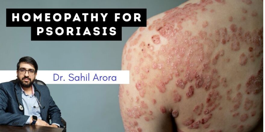 Homeopathic Medicine for Psoriasis