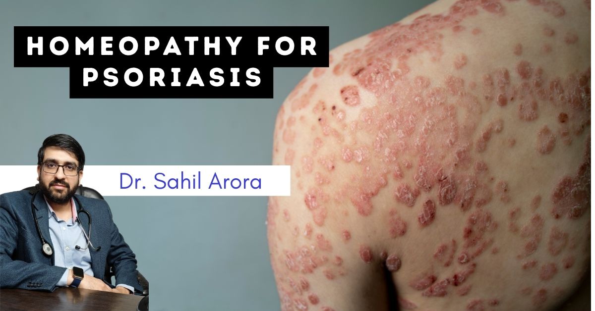 Homeopathic Medicine for Psoriasis 1 Homeopathic Medicine for Psoriasis