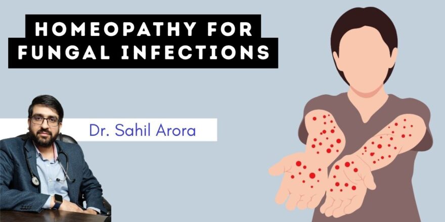 homeopathic remedies for fungal infection