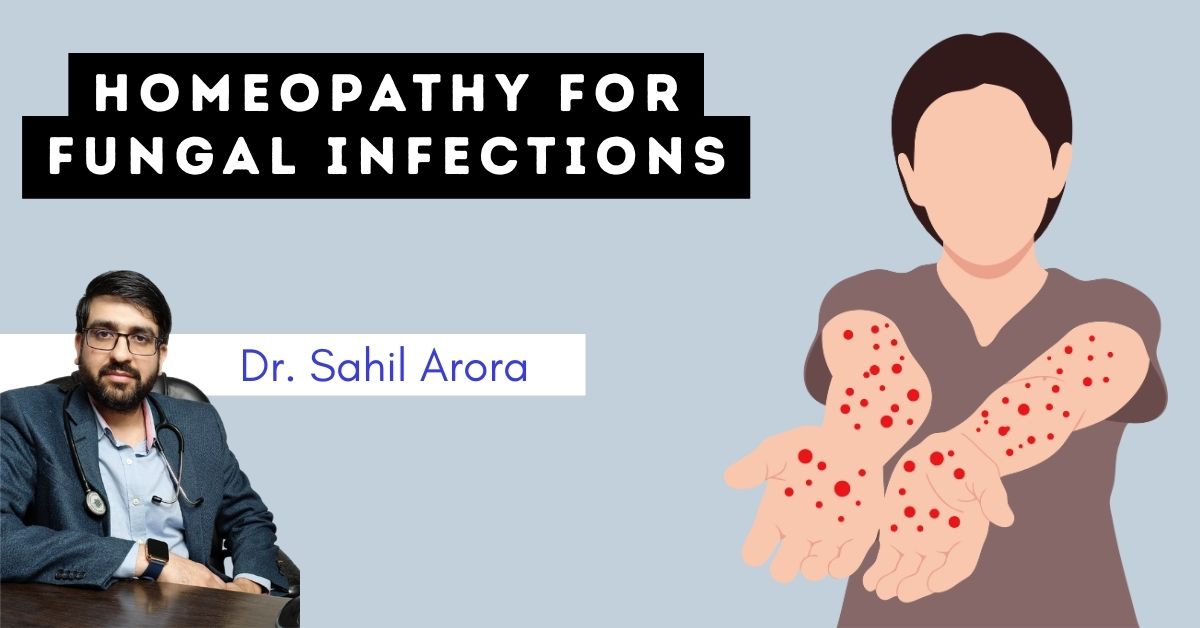 homeopathic remedies for fungal infection